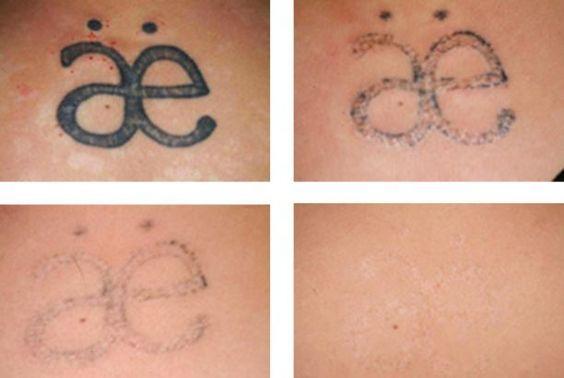 tattoo removal stages