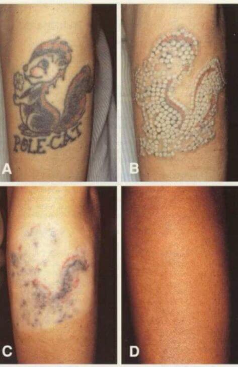 tattoo removal before and after laser