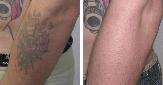 tattoo removal before and after laser