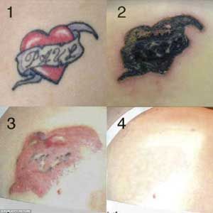 tattoo removal before and after